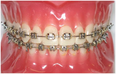 metal orthodontic brackets not corrode|orthodontic wire alloys.